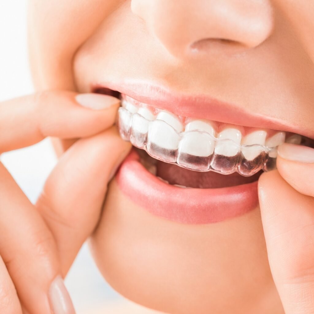 Orthodontics in Sharjah Spark clear aligners treatment