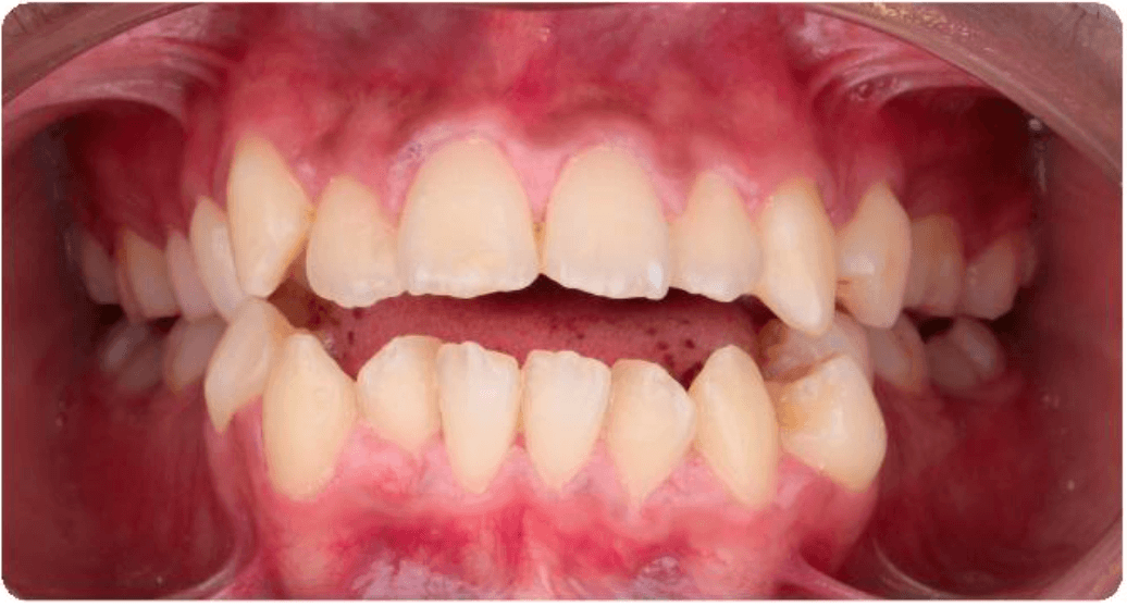 Before Orthodontic Treatment