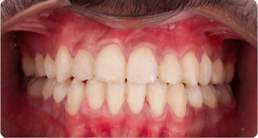 After Orthodontic Treatment