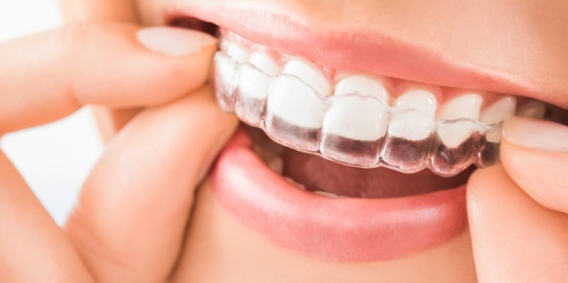 Orthodontics in Sharjah Spark clear aligners treatment