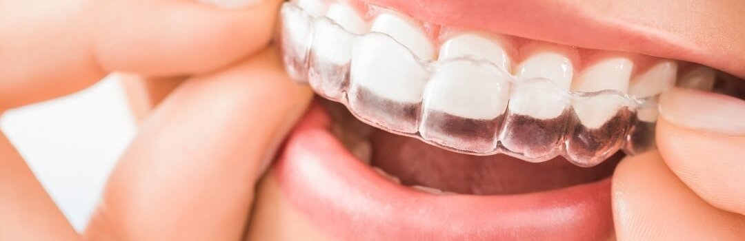 Orthodontics in Sharjah Spark clear aligners treatment